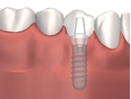 Implantate