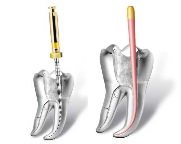 Endodontie