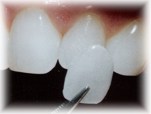 Non-Prep Veneers